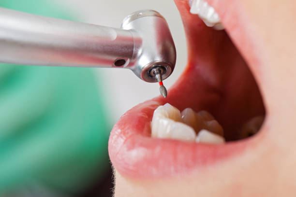 Best Lost Filling or Crown Replacement in Springfield, OH